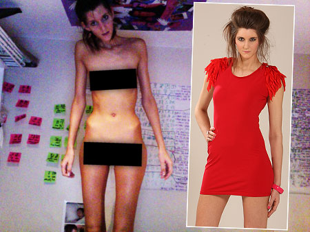 anorexic models. Anorexic Model Recovering